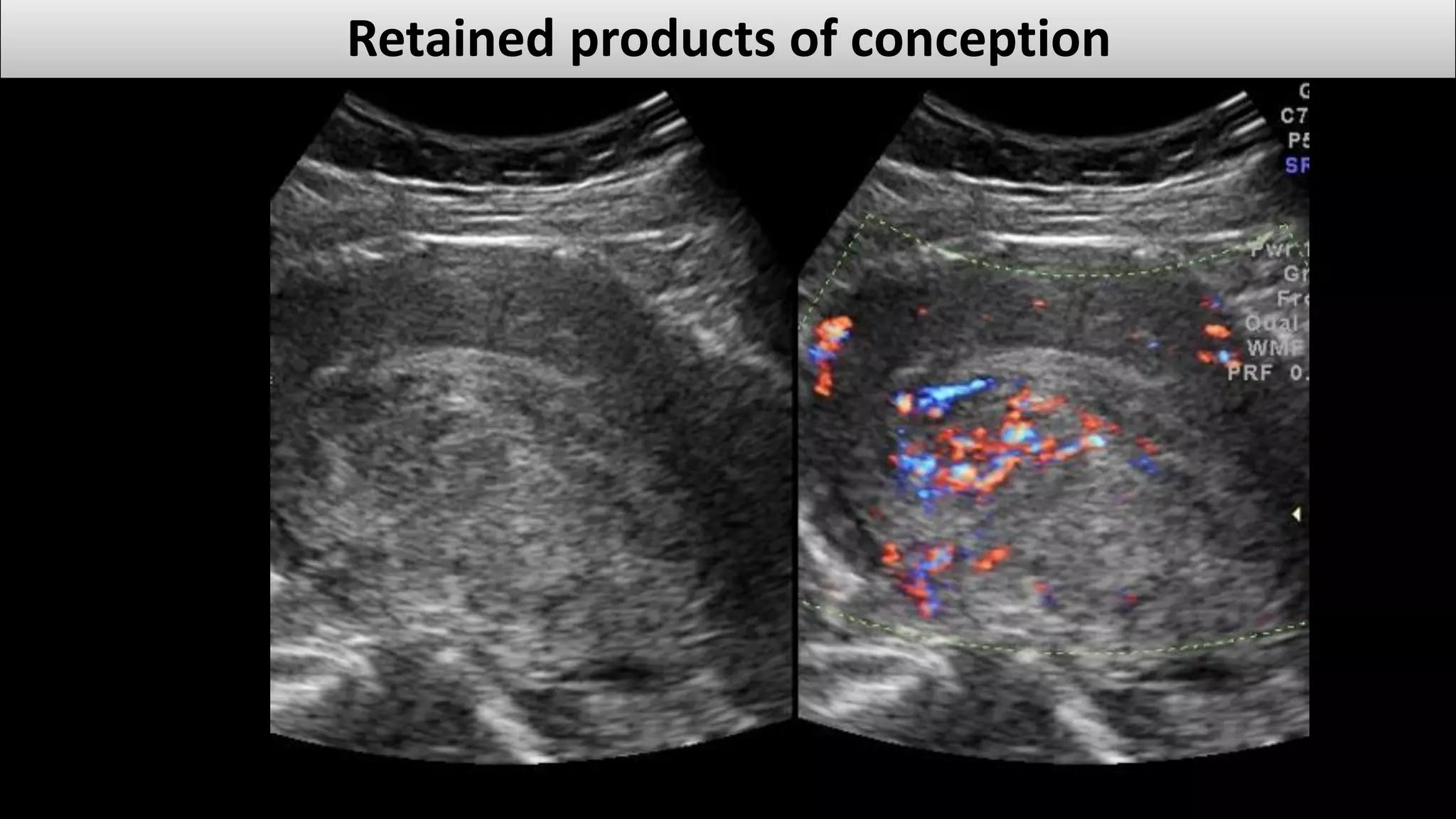 Hysteroscopic RPOC Removal in Pune – Safe & Advanced Uterine Cleaning Procedure